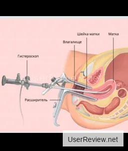 Uterine Fibroid Removal