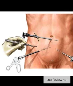 Appendix Laparoscopy