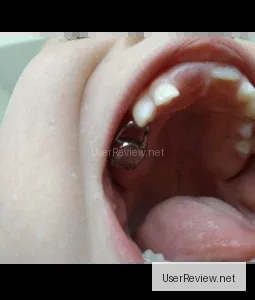 Zahnhalter für die Orthodontie / Raumhalter